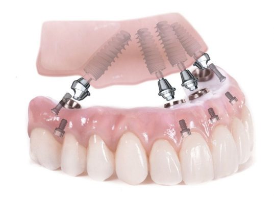 Quy trình cấy ghép răng Implant