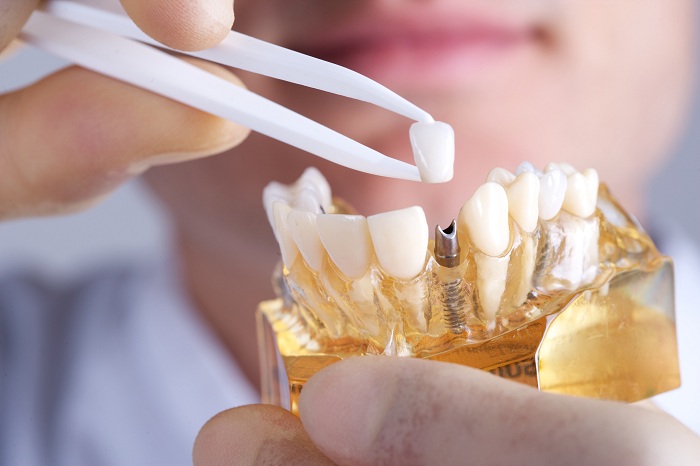 Thời gian cấy ghép răng implant là bao lâu