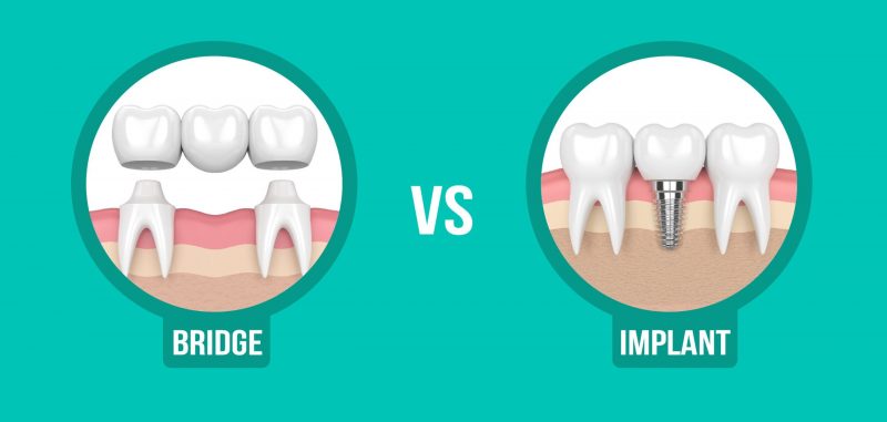 Bạn đã biết gì về cấy ghép răng implant hay chưa?