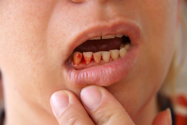 Biến chứng có thể gặp phải khi trồng răng Implant