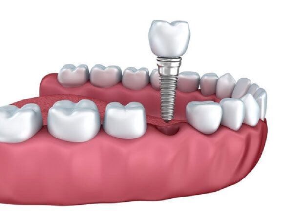 Chi phí trồng răng implant đơn lẻ
