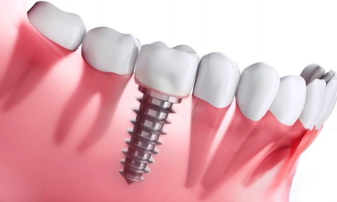 Quy trình cấy ghép răng có đau không?