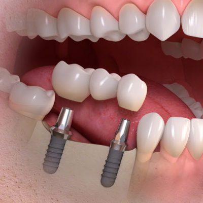 Có nên trồng răng Implant?