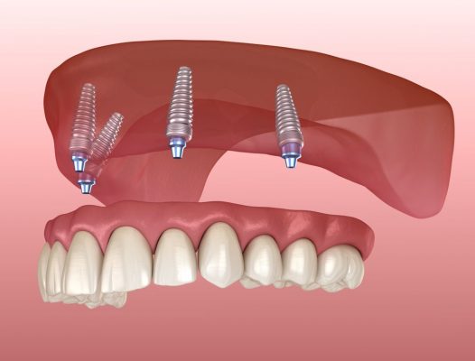 Có nên làm răng Implant không?
