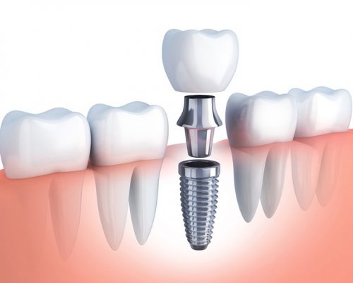 Có nên trồng răng implant trả góp không?