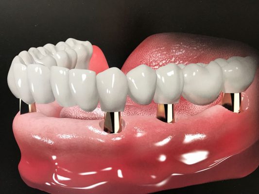 Trồng răng implant ở đâu tốt Tphcm 