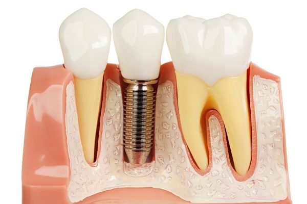 Dịch vụ trồng răng giả implant bao nhiêu tiền?