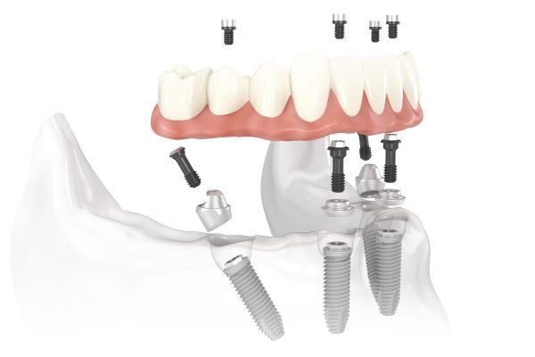 Dịch vụ trồng răng implant rất đẳng cấp