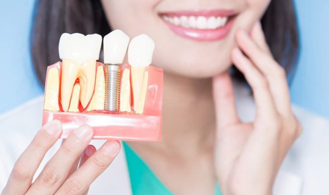 Giải đáp trồng răng Implant có tốt không?