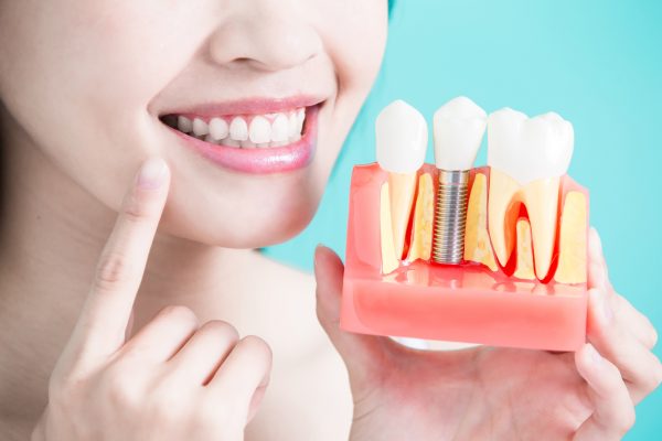 Khám lâm sàng rất cần thiết khi trồng răng Implant