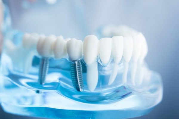 Kinh nghiệm làm răng Implant