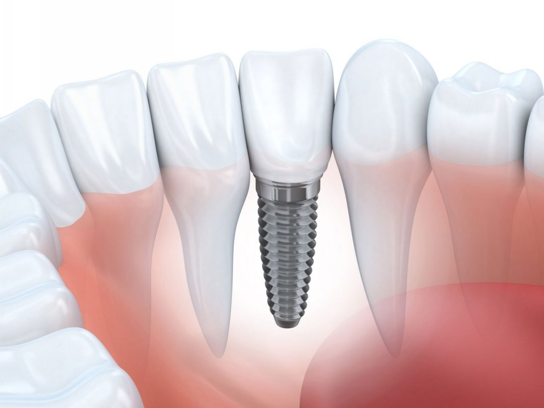 Kỹ thuật trồng răng implant có bền không?