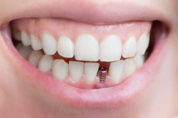 Lựa chọn địa chỉ phù hợp để trồng răng implant