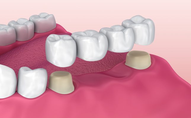 Mức giá trồng răng implant ở tphcm đắt không?