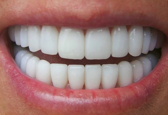 Nhiều người quan tâm trồng răng giả implant bao nhiêu tiền