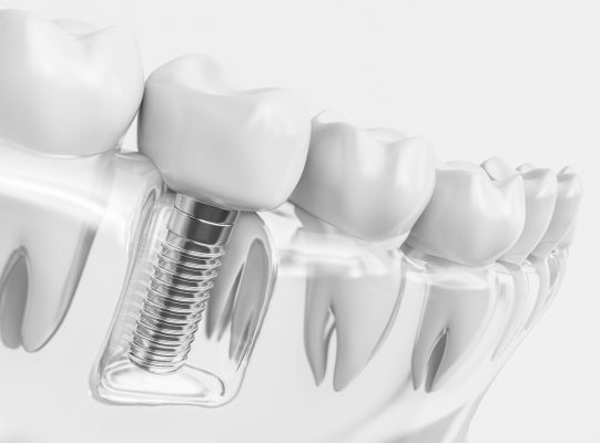 Sử dụng trụ kém chất lượng trồng răng implant có đau không?