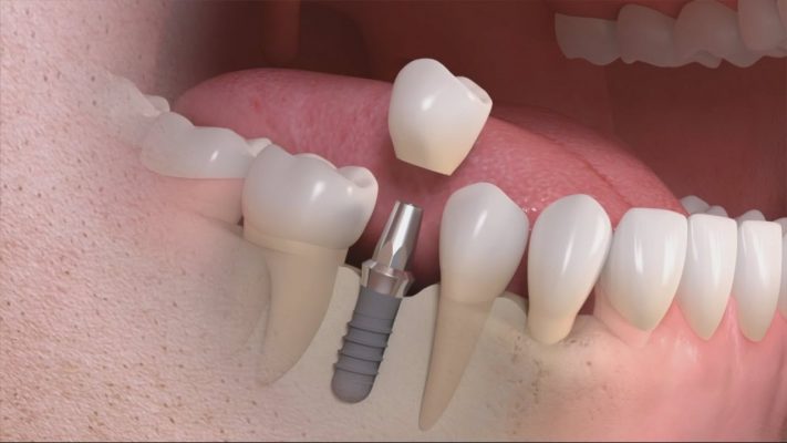 Tại sao phải cấy ghép Implant cho răng đã mất