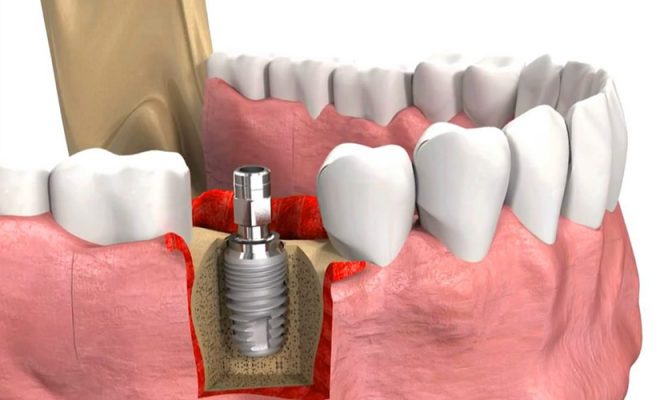 Toàn bộ quy trình trồng răng Implant