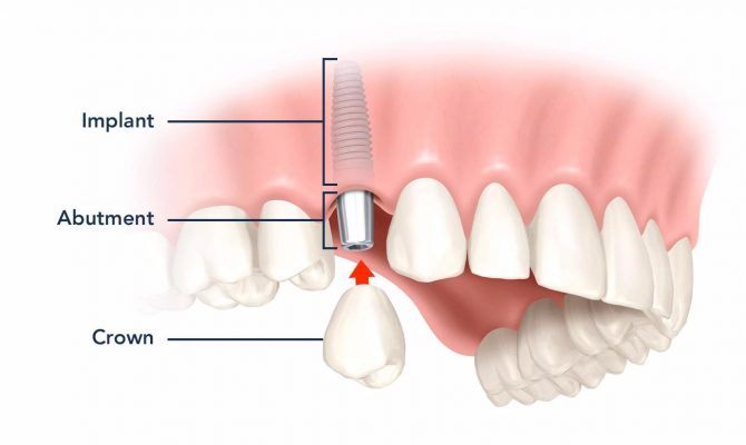 Trồng răng Implant trả góp uy tín