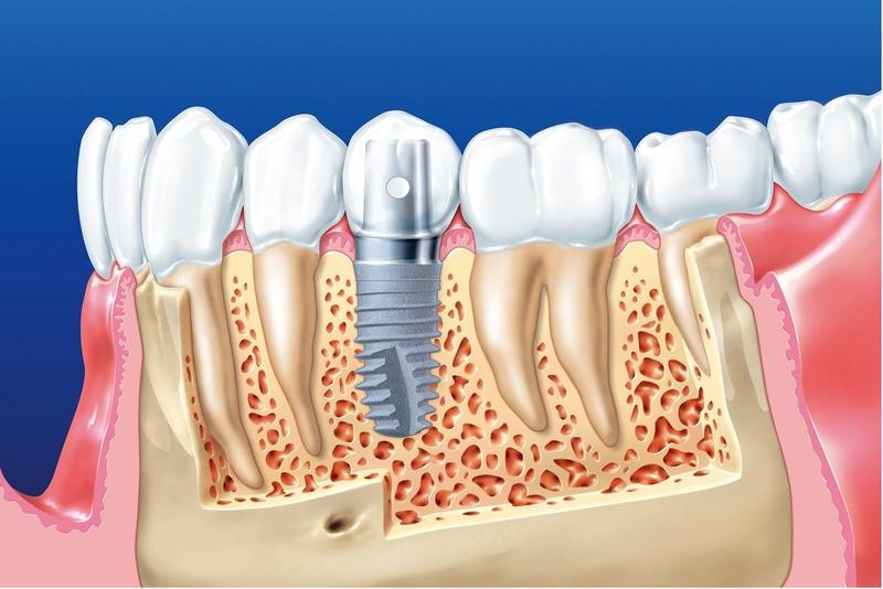 Trồng răng implant bao nhiêu tiền