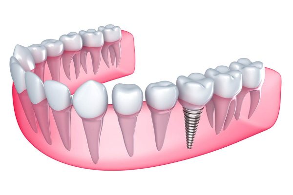Trồng răng Implant loại nào tốt?