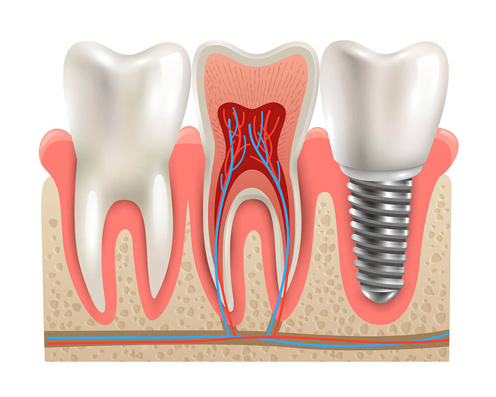 Trồng răng Implant ở đâu tốt TPHCM