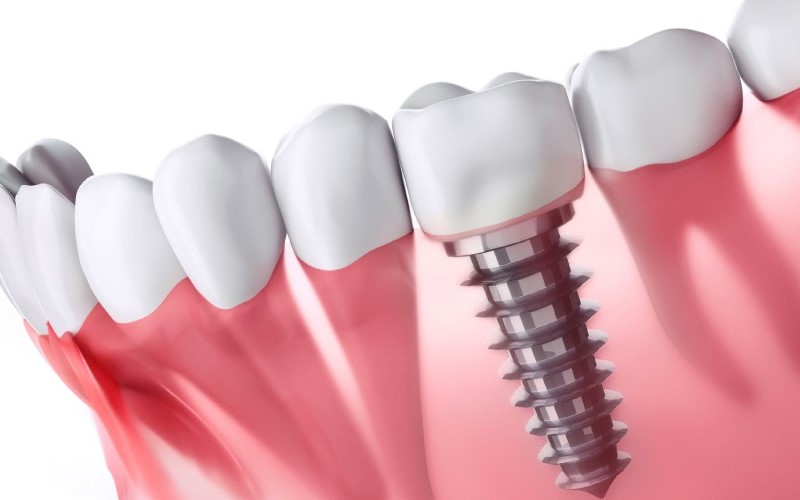 Cấy răng implant có đau không là thắc mắc của nhiều người muốn thực hiện kỹ thuật này