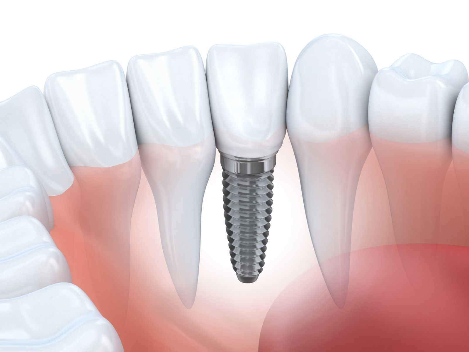 Kỹ thuật Implant nha khoa là gì? 