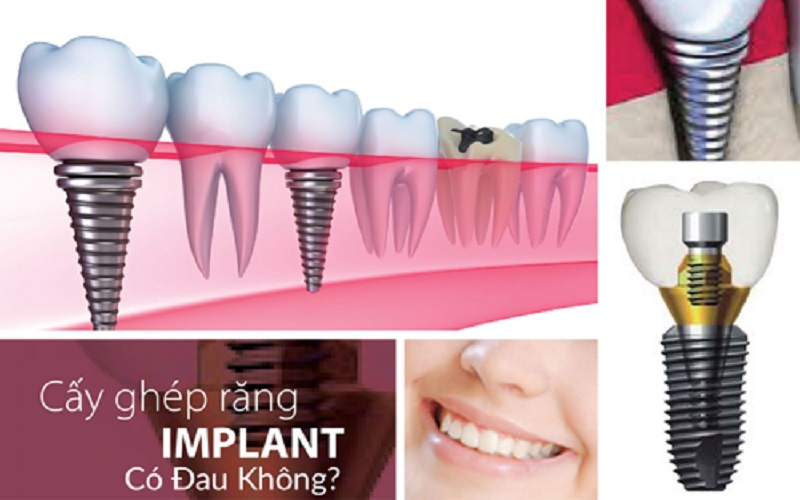 Làm răng Implant có đau không?