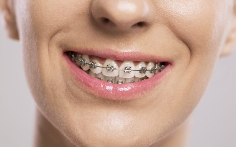 Niềng răng bằng mắc cài kim loại giúp chỉnh nha hiệu quả