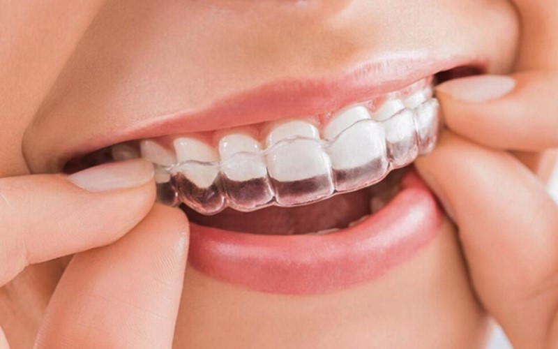 Quá trình niềng răng trong suốt