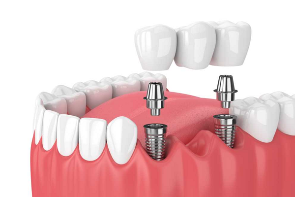 Ưu điểm khi cấy ghép răng Implant