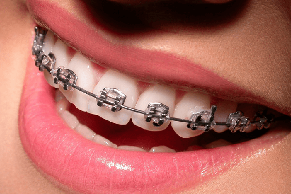 Niềng răng 1 hàm có được không?