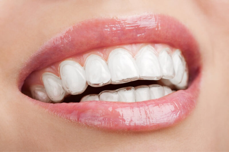 Niềng răng trong suốt – Niềng răng invisalign là gì?